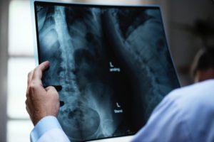 Spinal Cord Injuries After A South Carolina Car Accident